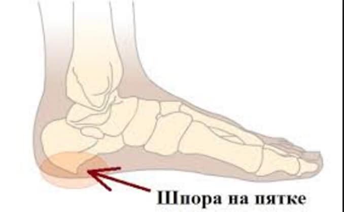 Причины возникновения шпор на пятке