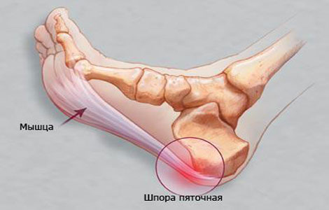 шпора на пятке