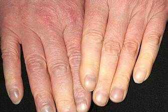 Первые признаки синдрома Рейно