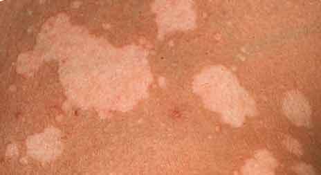 солнечный лишай