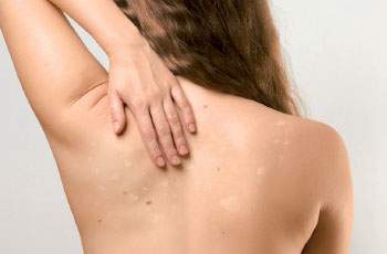 Чем лечить солнечный лишай