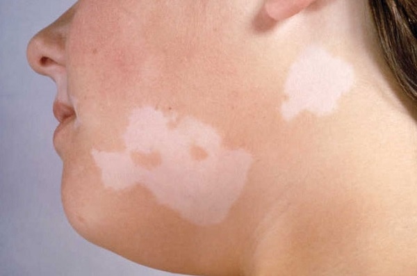 солнечный лишай