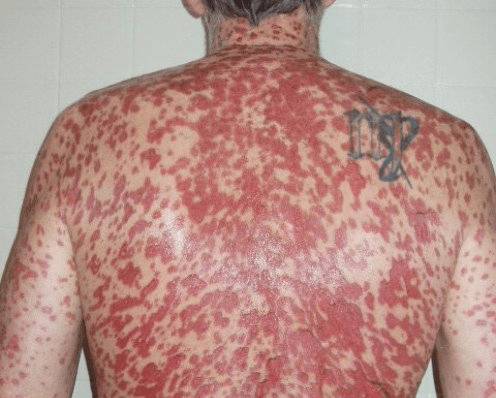 синдром стивенса джонсона