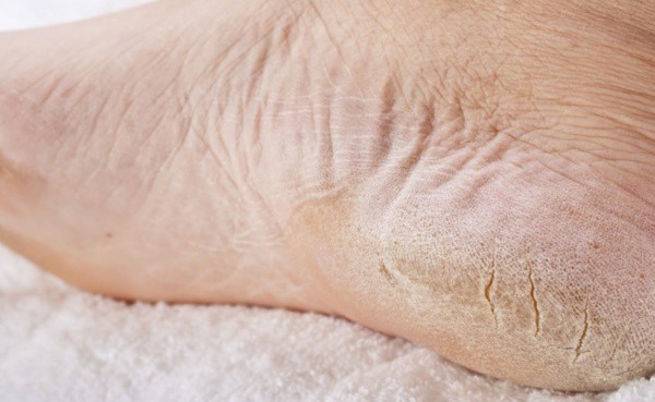 Причины сухой кожи на ногах