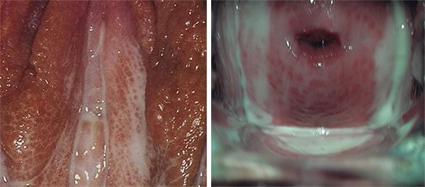 Первые признаки трихомониаза у женщин