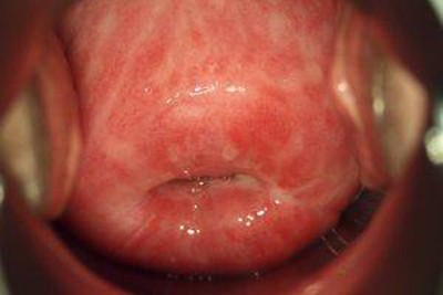 трихомониаз трихомониаз