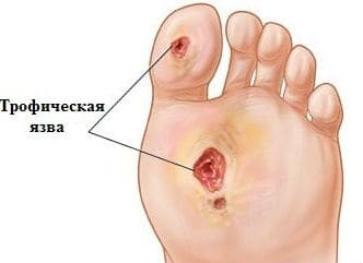 Лечение трофической язвы для больных сахарным диабетом