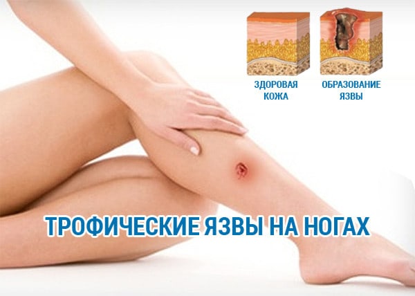 Причины и лечение трофических язв на ногах
