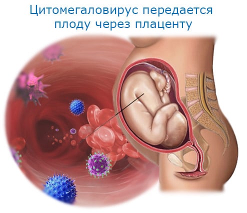 Цитомегаловирус у беременных