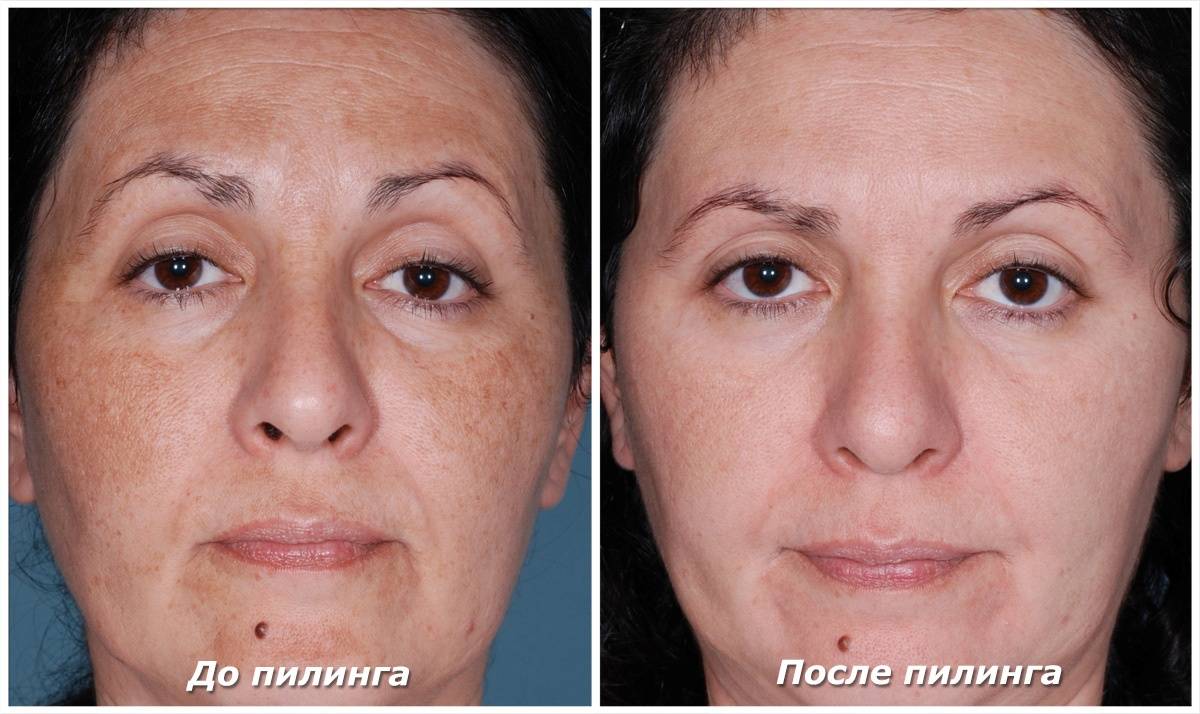 ультразвуковая чистка лица, фото до и после