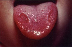 типун на языке типун на языке