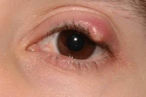 ячмень у ребенка