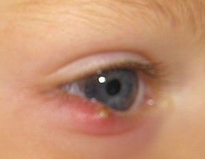 ячмень на глазу у ребенка ячмень на глазу у ребенка