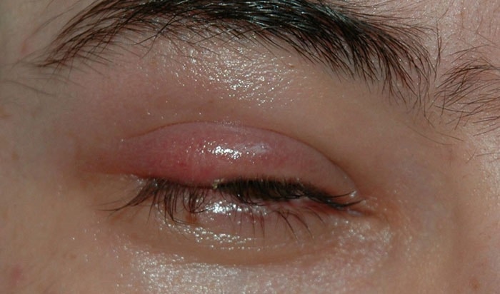 Лечение ячменя на глазу у ребенка