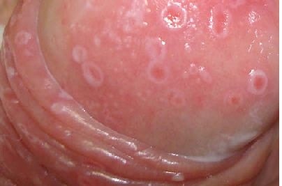 Лечение язвочек на головке члена у мужчин