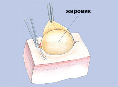 Опасны ли жировики на мошонке и как их убрать