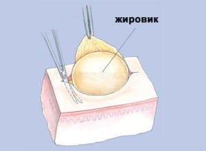 Причины прыщей на интимном месте у женщин
