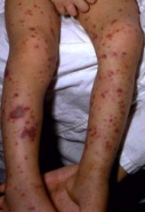 Ярко выраженная сыпь Ярко выраженная сыпь