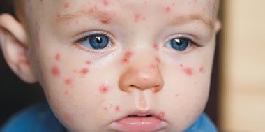 Сыпь при энтеровирусах у ребенка Сыпь при энтеровирусах у ребенка