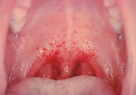 Фолликулярная ангина Фолликулярная ангина