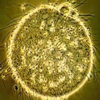 Гарднереллез Гарднереллез