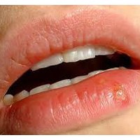 Герпес. Вирус Эпштейна-Барр Герпес. Вирус Эпштейна-Барр