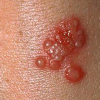 Герпес Герпес