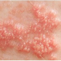 Герпес Герпес