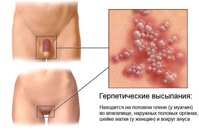Герпетические высыпания. Признак генитального герпеса Герпетические высыпания. Признак генитального герпеса