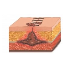 Гнилостная инфекция Гнилостная инфекция