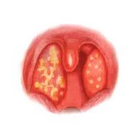 Гнойная ангина - миниатюра Гнойная ангина - миниатюра