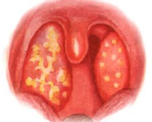 Как выглядит гнойная ангина Как выглядит гнойная ангина