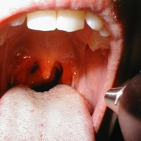 Осмотр миндалин Осмотр миндалин