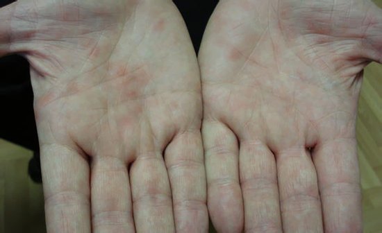 Высыпания при иерсиниозе Высыпания при иерсиниозе