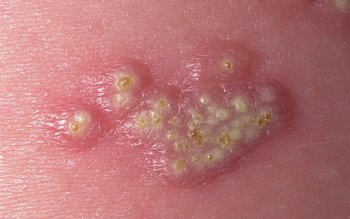 Герпес на фото Герпес на фото