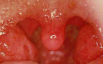 Как выглядит катаральная ангина Как выглядит катаральная ангина