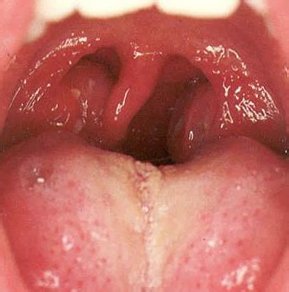 Катаральная ангина Катаральная ангина