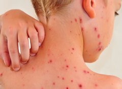 Корь Корь у ребенка