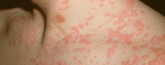 Краснуха Краснуха