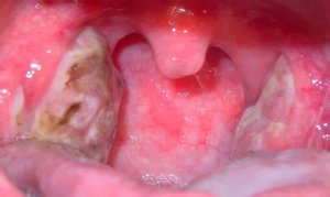 Острое течение тонзиллита Острое течение тонзиллита