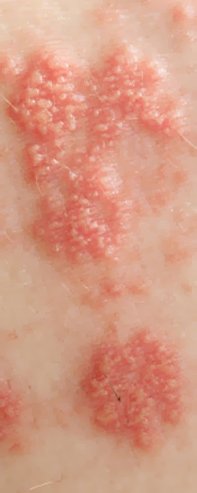 Сыпь из пузырьков - симптом герпеса Сыпь из пузырьков - симптом герпеса