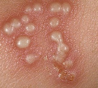 Пузырьки при герпесе Пузырьки при герпесе