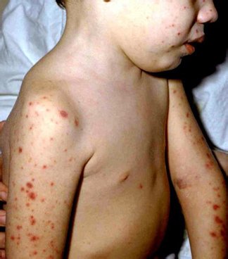 Сыпь у ребенка Сыпь у ребенка