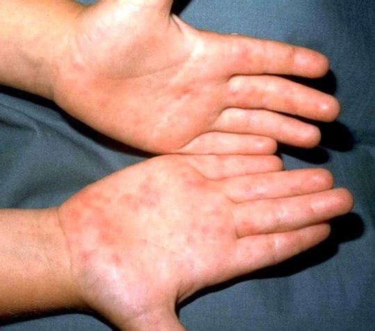 Сыпь при энтеровирусах на руках Сыпь при энтеровирусах на руках