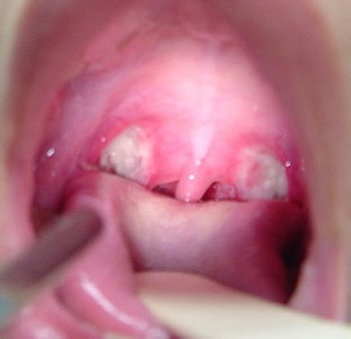 Тонзиллит Тонзиллит