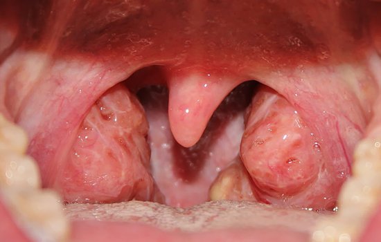 Увеличенные миндалины - симптом тонзиллита Увеличенные миндалины - симптом тонзиллита