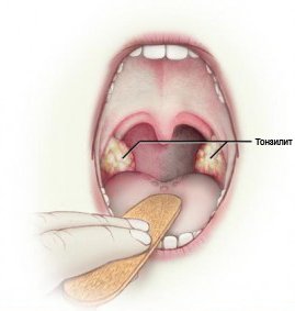Тонзиллит Тонзиллит