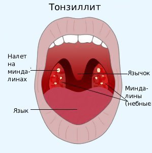 Тонзиллит Тонзиллит