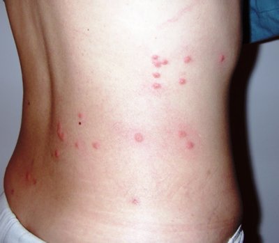 Как выглядит брюшной тиф у больного Как выглядит брюшной тиф у больного