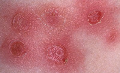 Высыпания пузырьков Высыпания пузырьков